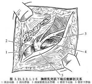 胸锁乳突肌下端切断术