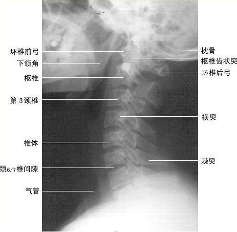 颈椎侧位