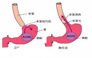 食管下括约肌