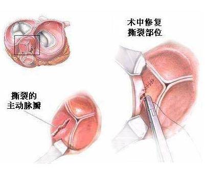 风湿性多肌病