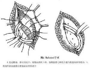 成人腹股沟斜疝