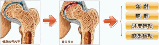 糖尿病骨关节病