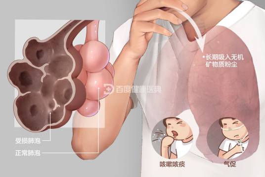 肺尘埃沉着病