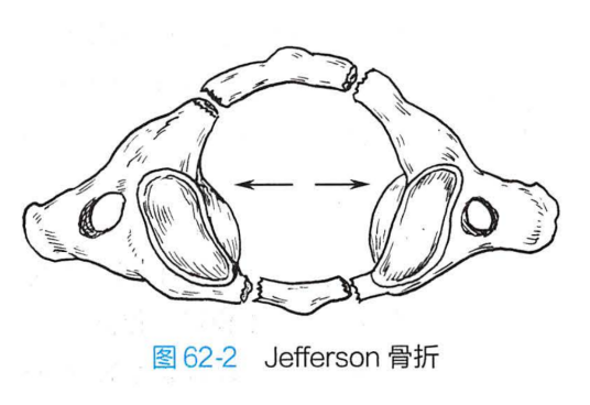 Jefferson骨折