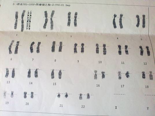 精子染色体检查