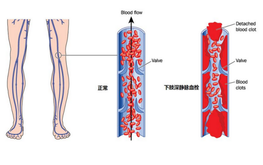 深静脉血栓