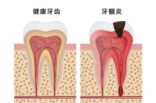 急性牙髓炎