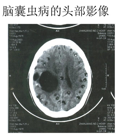 脑囊虫病