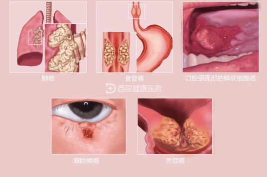 鳞状细胞癌