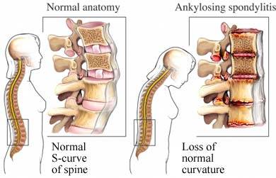 儿童强直性脊柱炎
