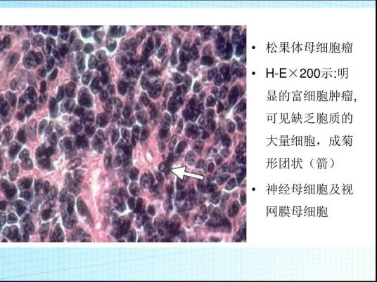 松果体母细胞瘤