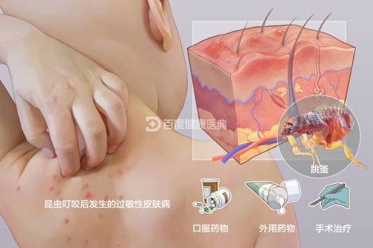 丘疹性荨麻疹