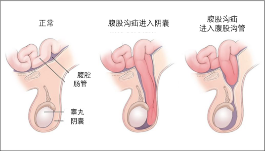 小儿疝气